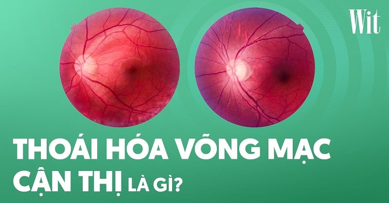 Thoái hóa võng mạc cận thị