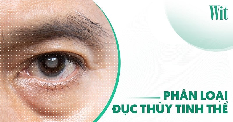 phân loại đục thủy tinh thể