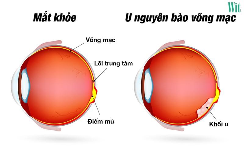 u nguyên bào võng mạc