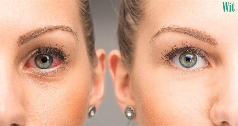 nguyên nhân khô mắt ở người già