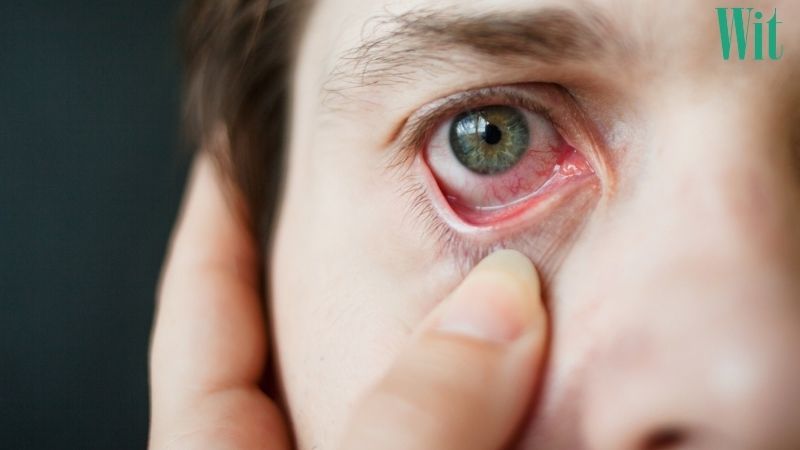 mờ mắt sau khi bị viêm kết mạc