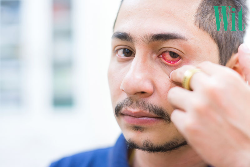 nguyên nhân gây viêm kết mạc có giả mạc