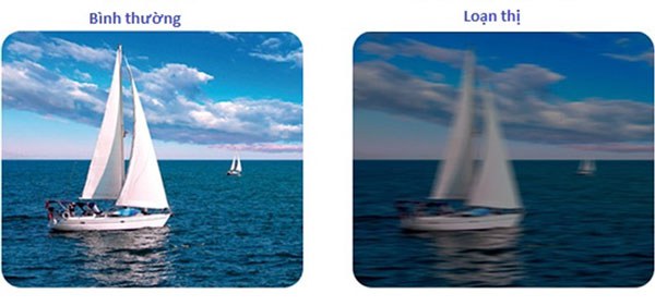 tình trạng viễn loạn thị