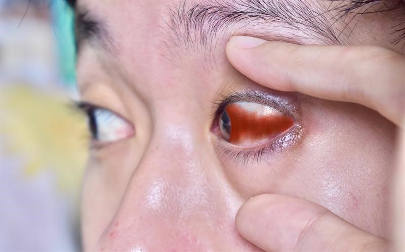 Xuất huyết dưới kết mạc là tình trạng thường gặp ở người sử dụng rượu bia, thuốc lá sau phẫu thuật