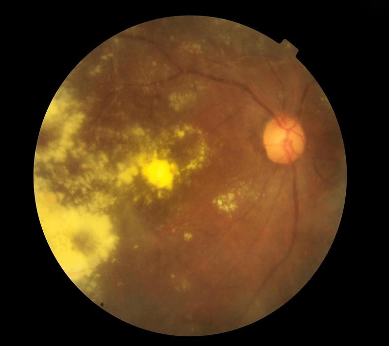 hắc võng mạc trung tâm