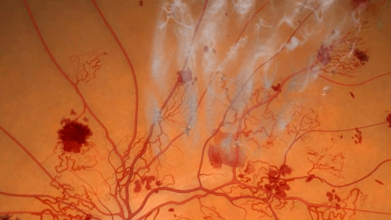 mạch máu võng mạc