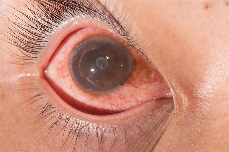 viêm màng bồ đào