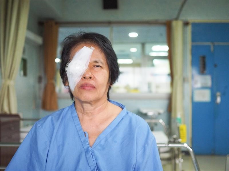 Cách chăm sóc mắt sau mổ đục thủy tinh thể đúng cách tại nhà