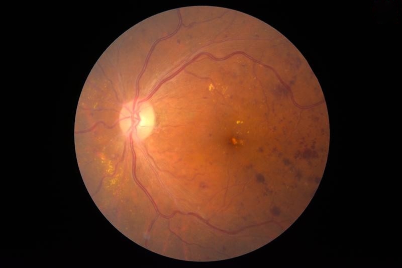 bệnh về võng mạc