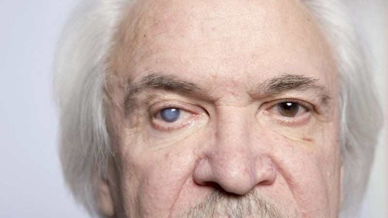 Đục thủy tinh thể là bệnh lý nguy hiểm ở mắt và là nguyên nhân hàng đầu gây mù lòa trên thế giới và tại Việt Nam