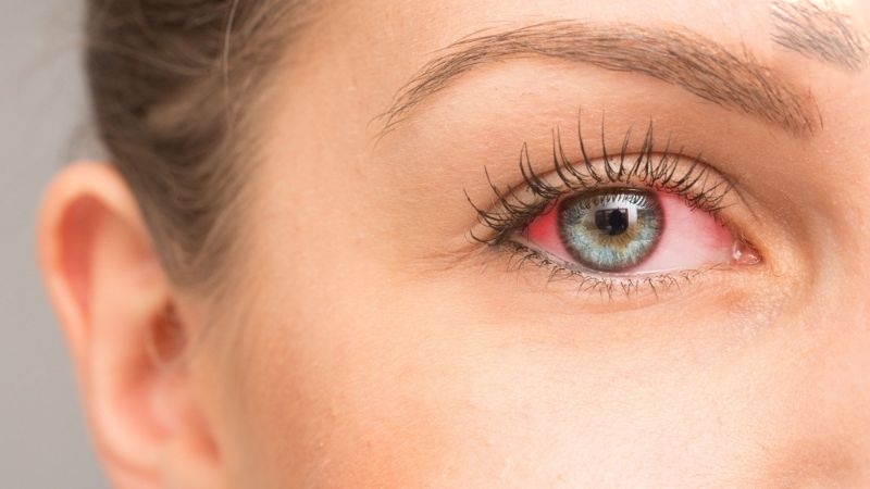 khô mắt do thiếu vitamin