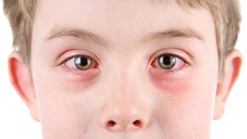 Viêm kết mạc dị ứng có thể xảy ra với cả trẻ em, phổ biến từ 5 tuổi