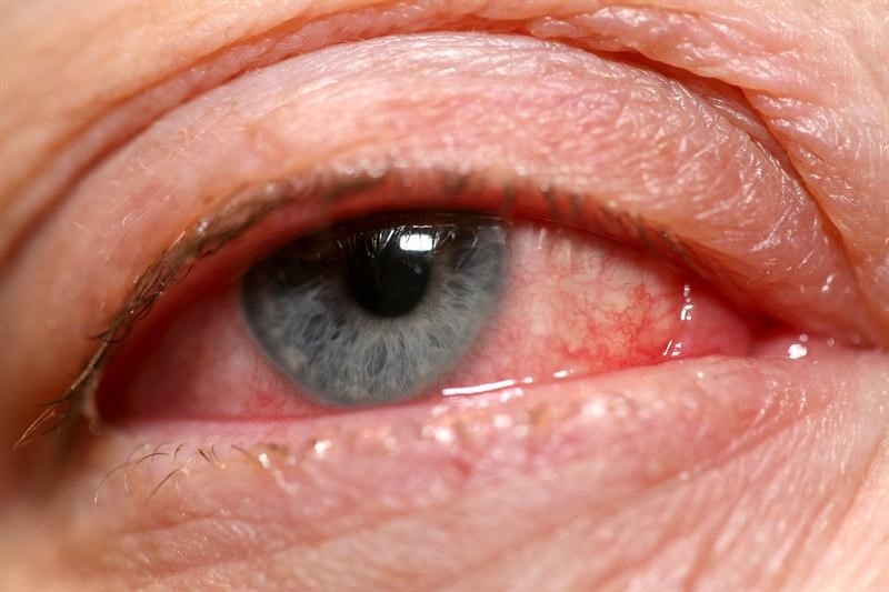 biến chứng của đau mắt đỏ