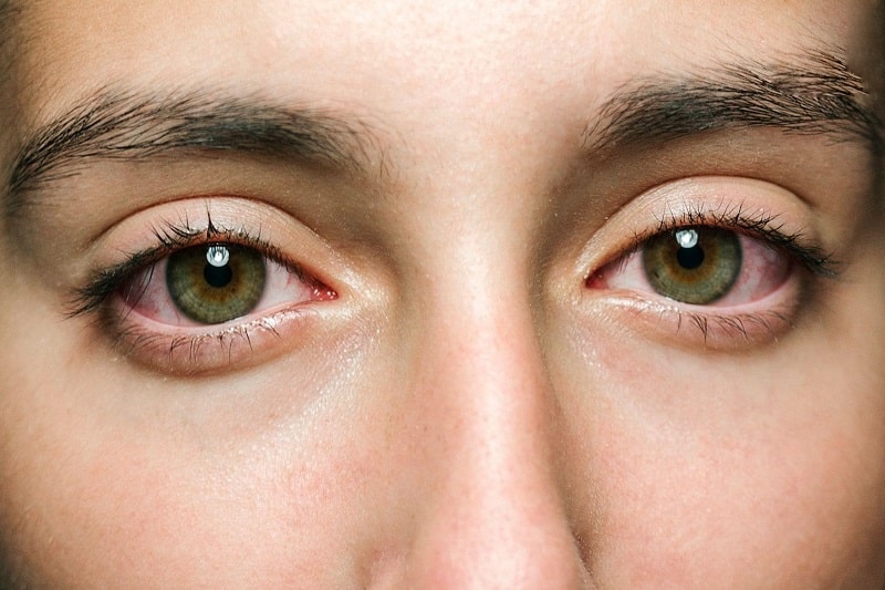 dấu hiệu bà bầu bị đau mắt đỏ