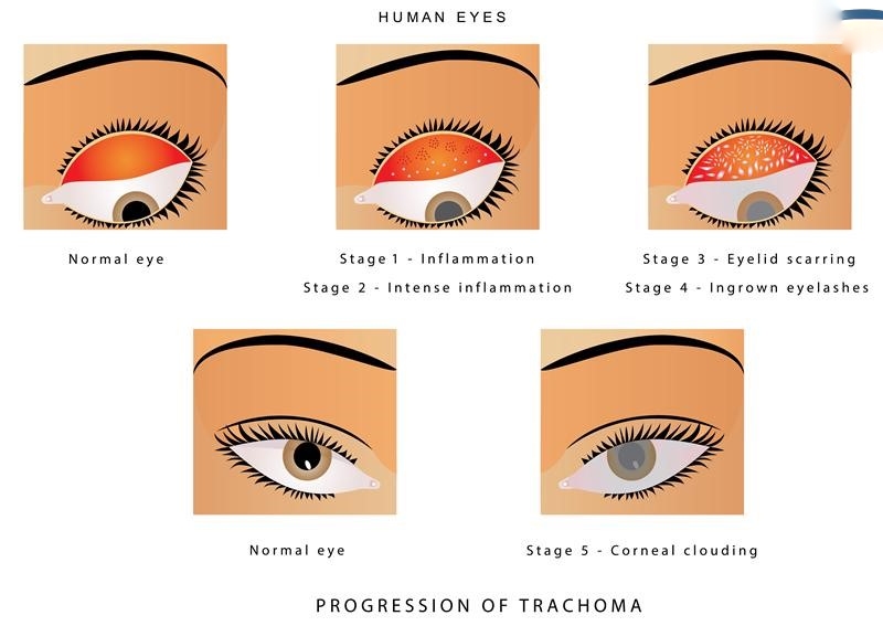 giai đoạn đau mắt hột