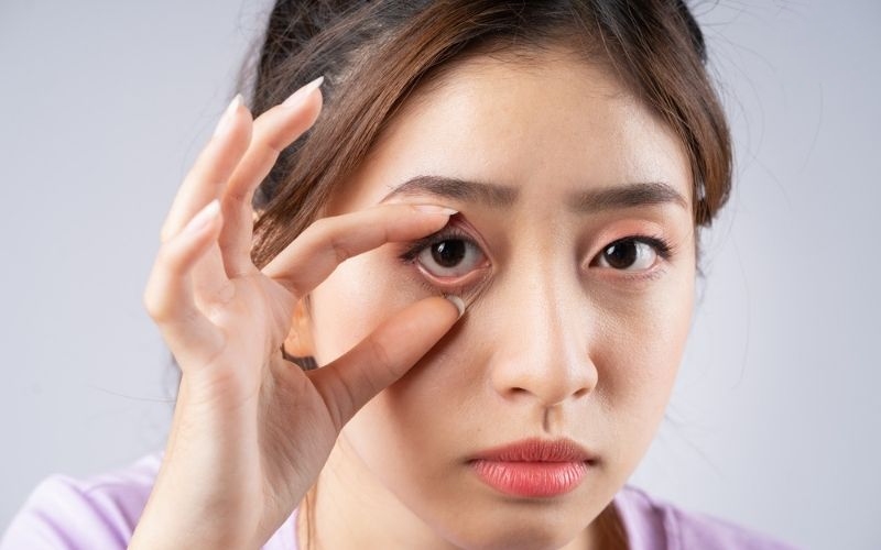 vì sao tái cận sau mổ lasik