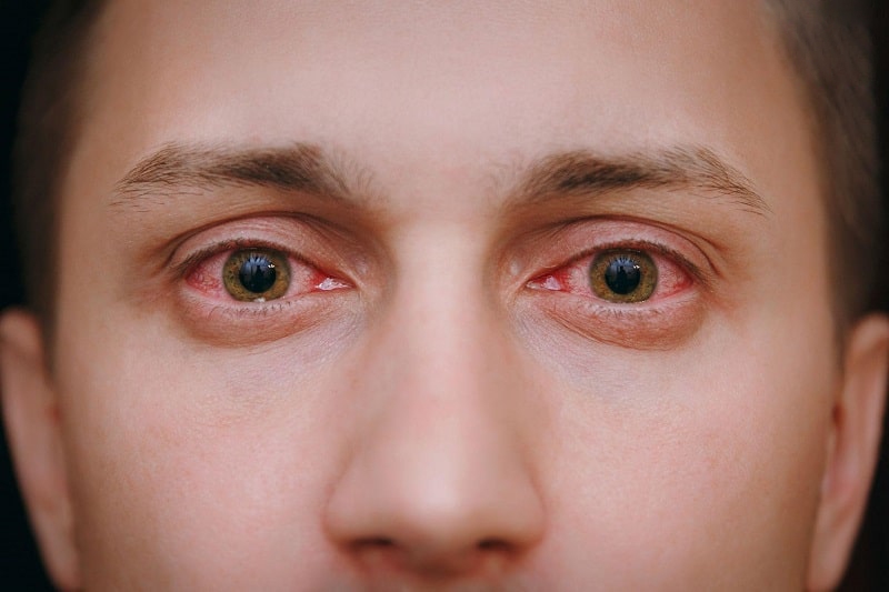 viêm kết mạc cấp tính