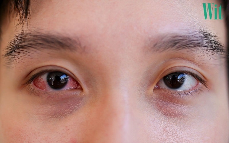 viêm kết mạc lâu ngày không khỏi