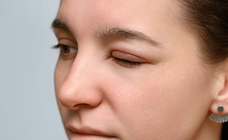 cách làm mắt hết sưng