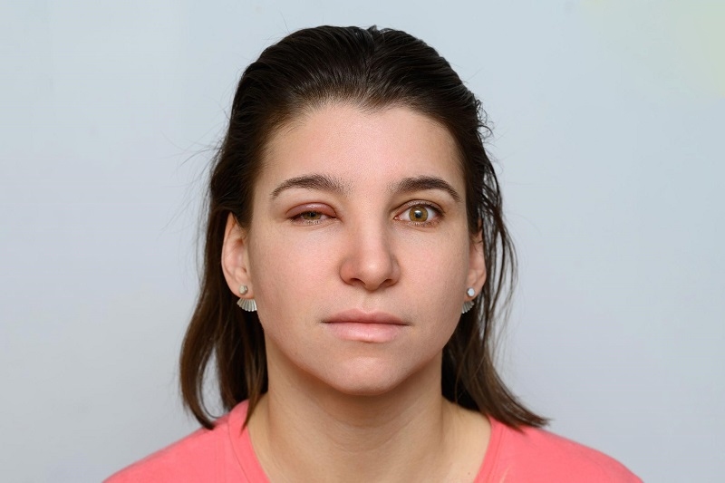 mí mắt bị sưng khi ngủ dậy