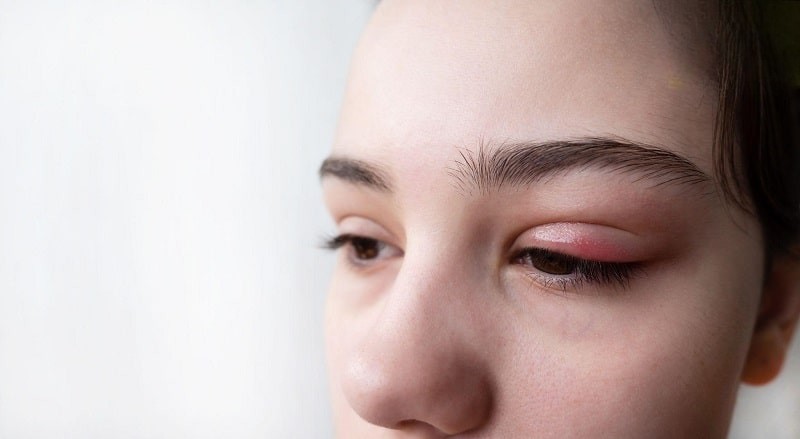 Mí mắt bị sưng do nhiều nguyên nhân gây ra, bị chắp hoặc bị lẹo là 2 nguyên nhân thường gặp