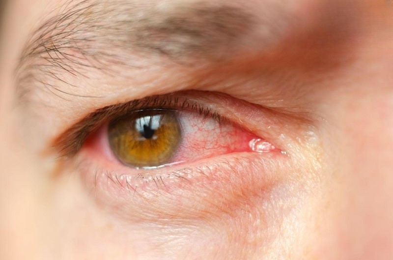 Mắt bị đau khi chớp có thể do bệnh lý viêm kết mạc gây ra