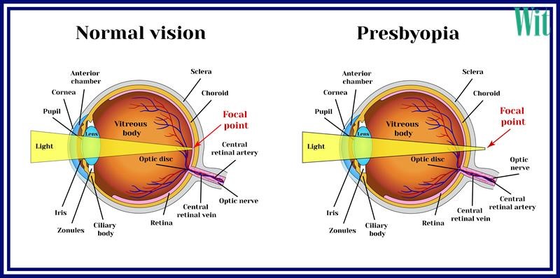 Các tật khúc xạ của mắt và cách khắc phục hiệu quả
