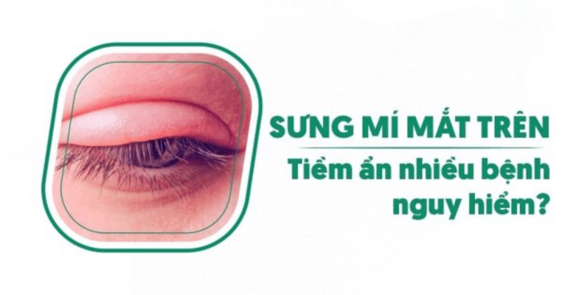 Sưng mí mắt trên: Nguyên nhân, dấu hiệu và cách điều trị