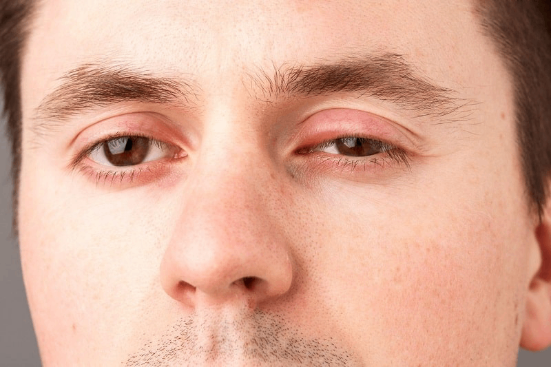 sưng nhẹ mí mắt