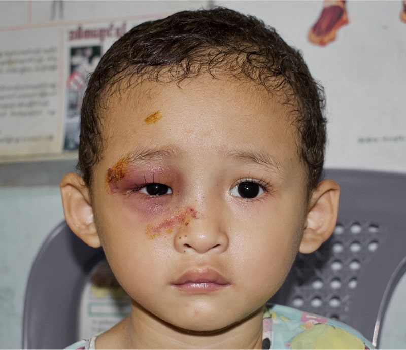 biến chứng nguy hiểm khi không trị sưng mí mắt