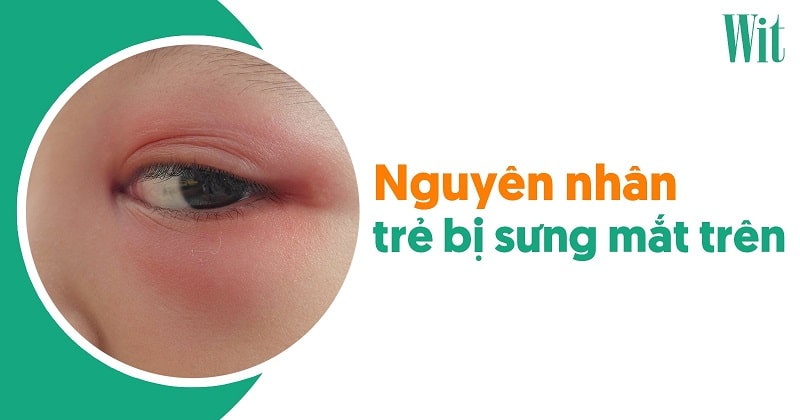 Trẻ bị sưng mí mắt trên – 8 nguyên nhân phổ biến và cách xử lý