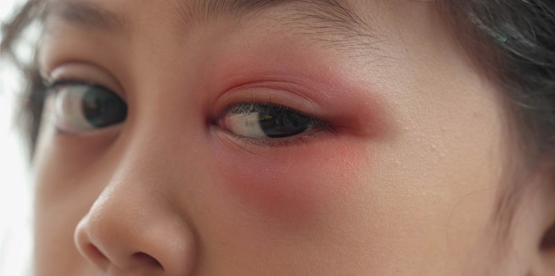 trẻ bị sưng mí mắt trên