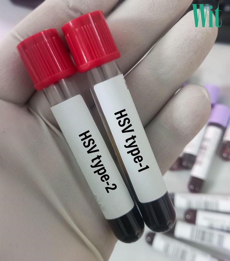 Viêm kết mạc do virus