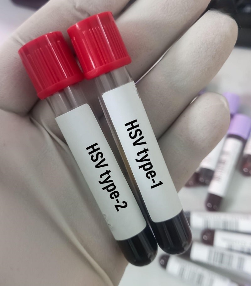 Viêm kết mạc do virus