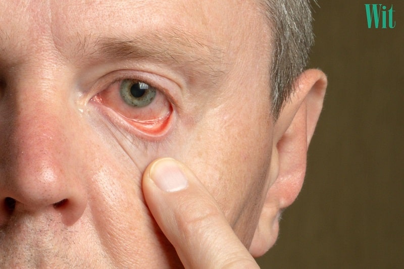 Viêm kết mạc do virus