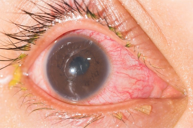 Viêm mống mắt thể mi