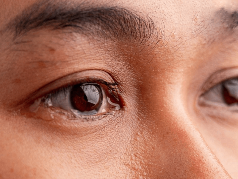 sưng mí chảy nước mắt