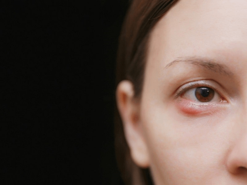 sưng mí mắt dưới trái