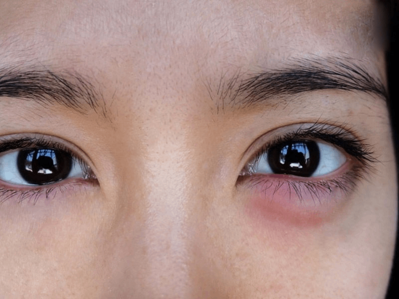 sưng mí mắt dưới