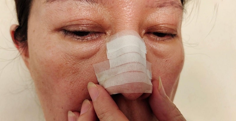 viêm túi lệ là gì