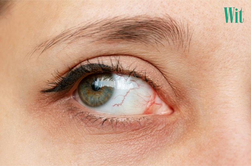 Xuất huyết mắt