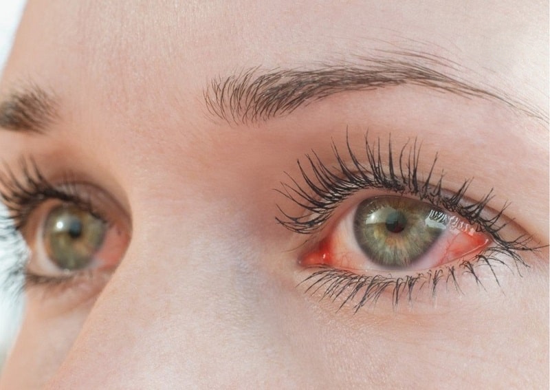 nguyên nhân ngứa mắt trái