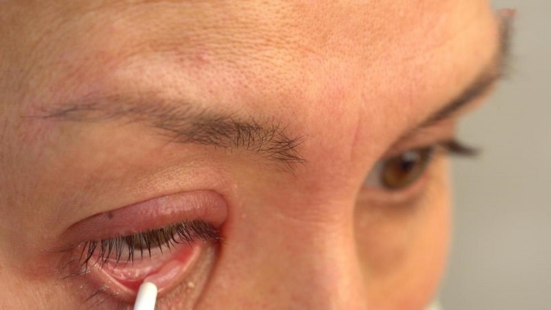 Thuốc mỡ tra mắt