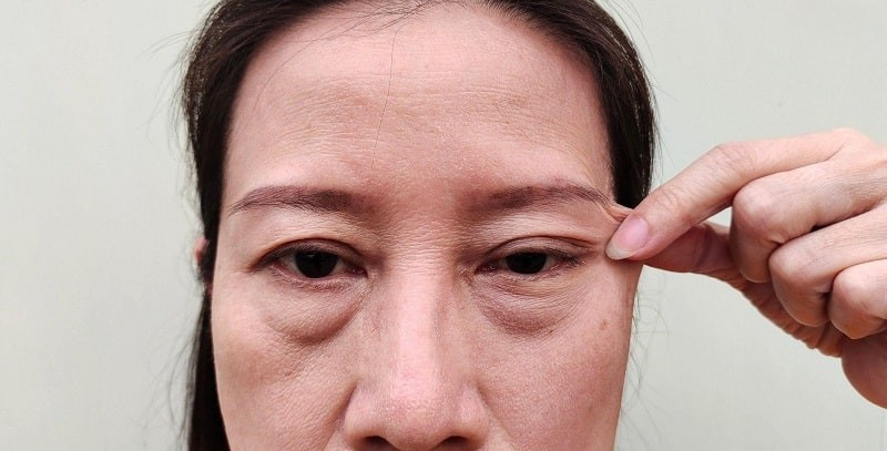 Bọng mắt dưới mí mắt khiến khuôn mặt trở nên già nua, thiếu sức sống