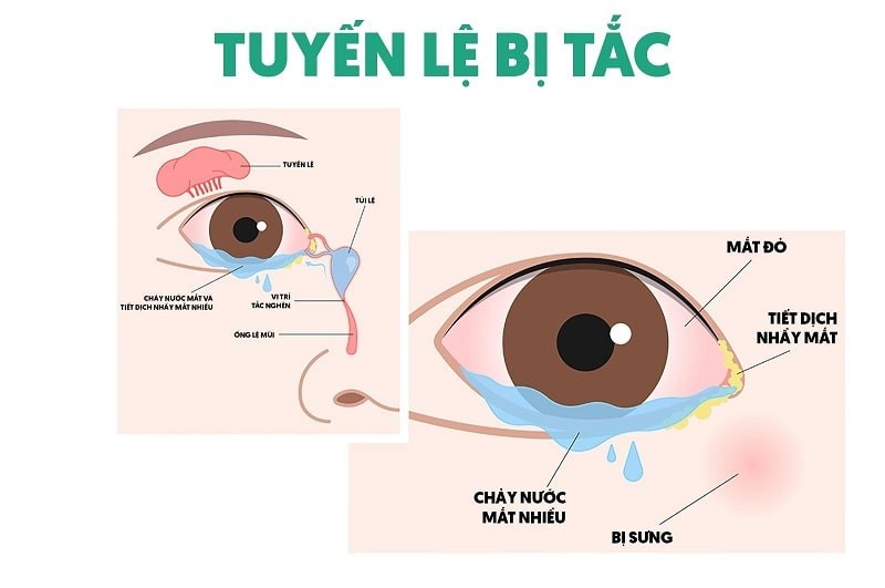 triệu chứng tắc tuyến lệ