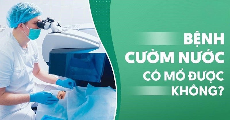 Mắt bị cườm nước có mổ được không? Phẫu thuật có an toàn?