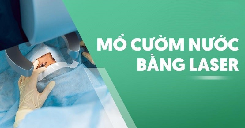 Mổ cườm nước bằng laser phục hồi thị lực nhanh chóng ra sao?