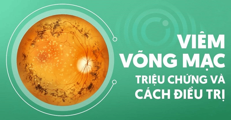 Viêm võng mạc: Nguyên nhân, dấu hiệu và cách điều trị