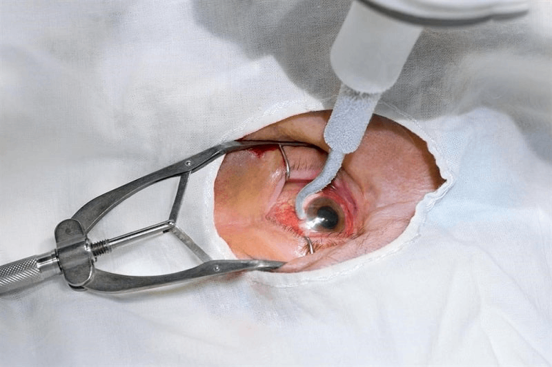 bác sĩ phẫu thuật bong võng mạc