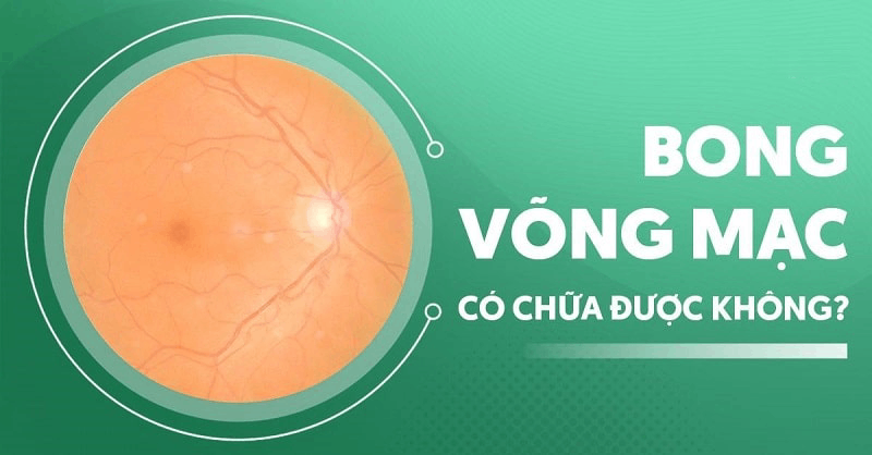 Bong võng mạc có chữa được không? Điều trị ra sao?